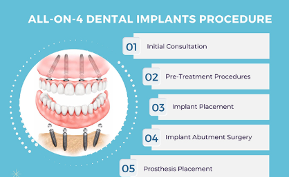 dental veneers in pragathi nagar