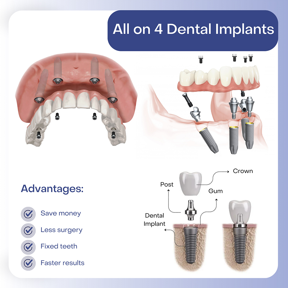 dental veneers in pragathi nagar