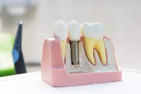 dental veneers in pragathi nagar
