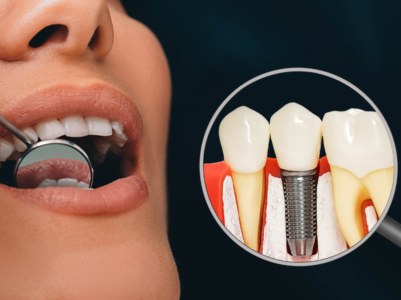 dental veneers in pragathi nagar