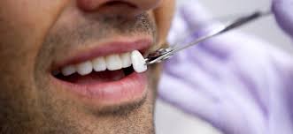 dental veneers in pragathi nagar