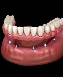 dental veneers in pragathi nagar