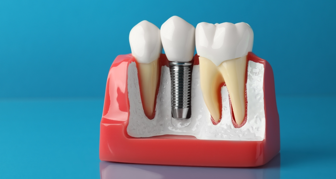 dental veneers in pragathi nagar