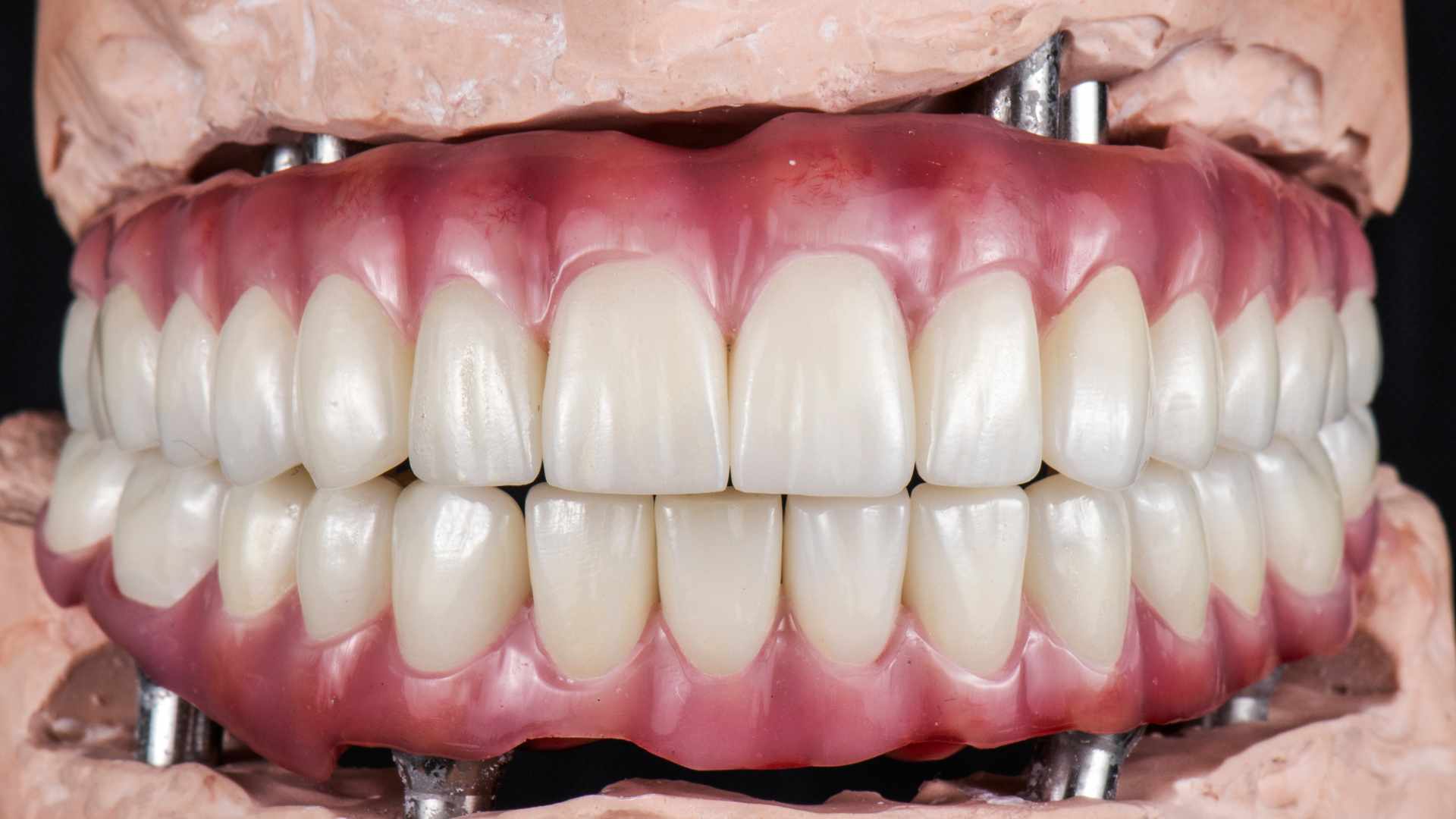 dental veneers in pragathi nagar