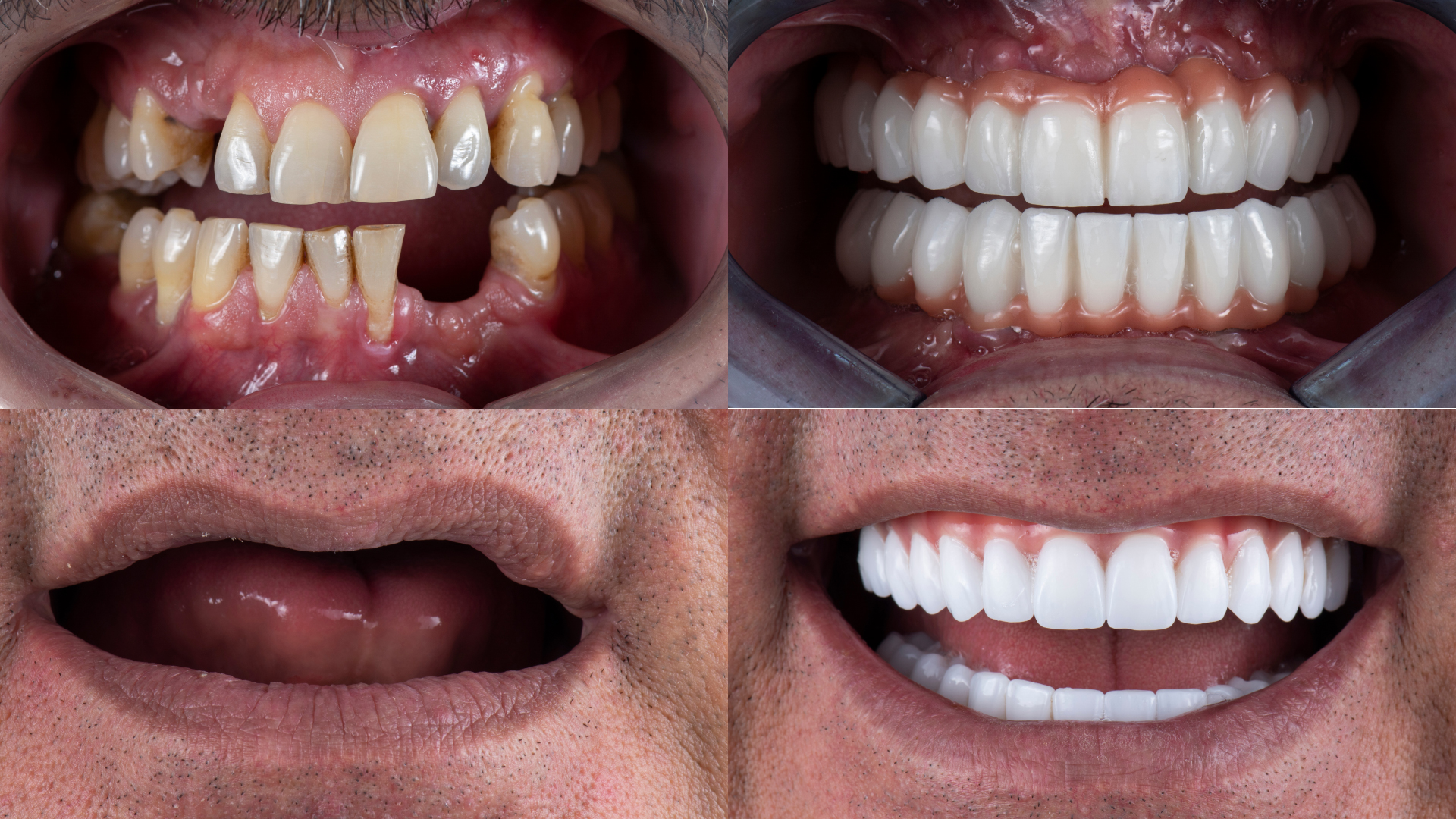 dental veneers in pragathi nagar