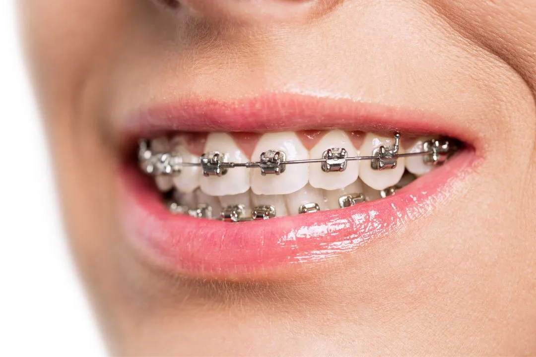 braces and aligners