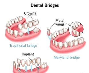 dental crowns and bridges