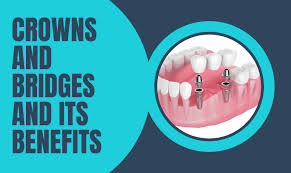 dental crowns and bridges