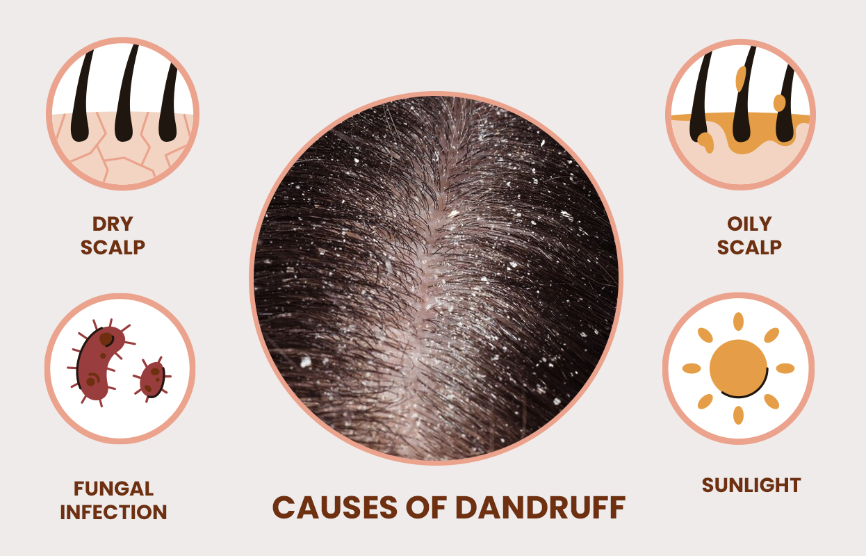 beat dandruff