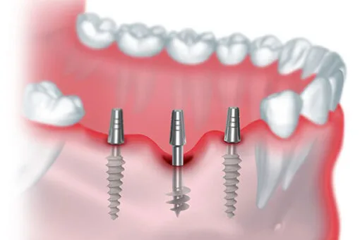 Wisdom Teeth Symptoms