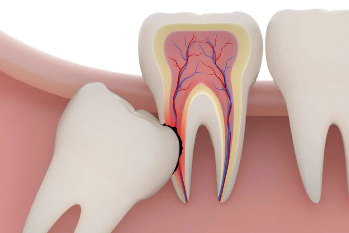 Wisdom Teeth Removal