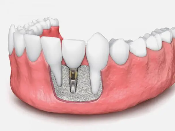 Surgical Procedure