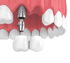 dental veneers in pragathi nagar