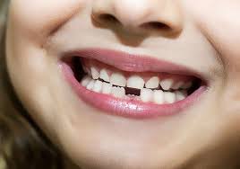 dental veneers in pragathi nagar