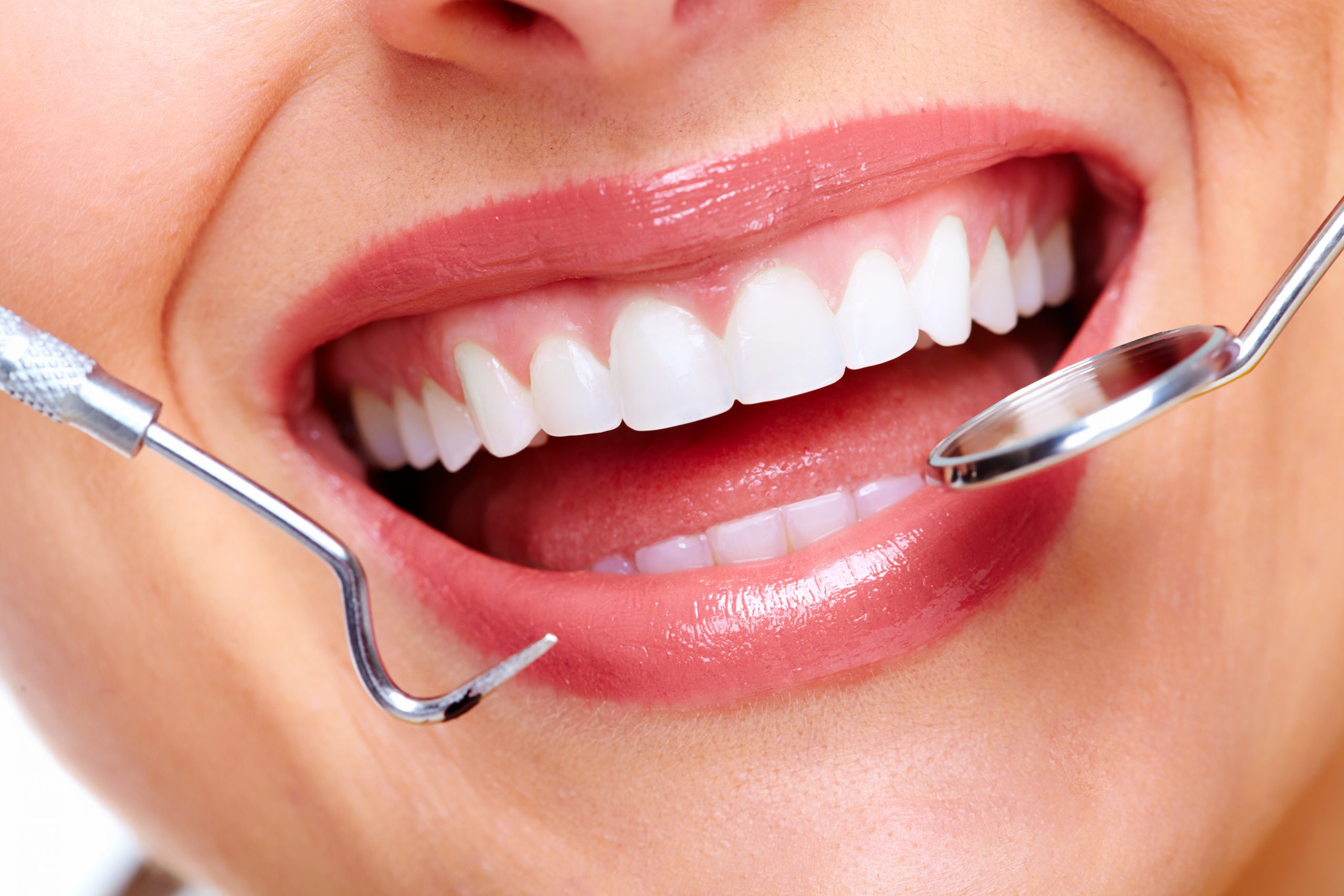 dental veneers in pragathi nagar