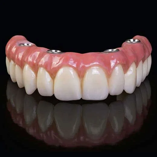 dental veneers in pragathi nagar