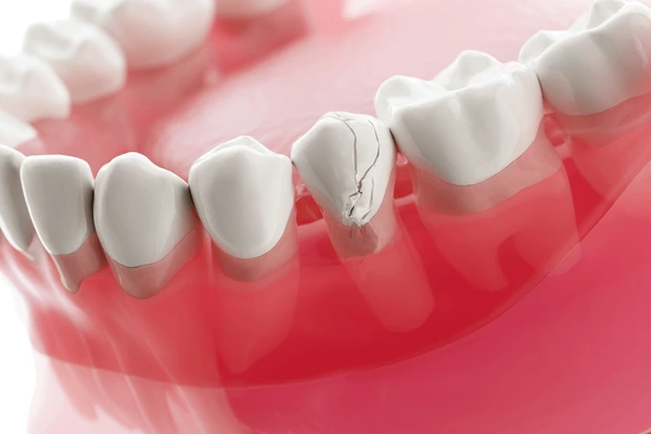 dental veneers in pragathi nagar