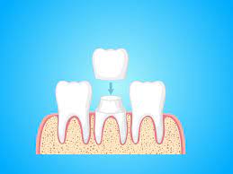 dental veneers in pragathi nagar