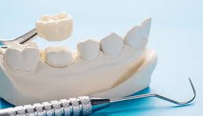 dental veneers in pragathi nagar