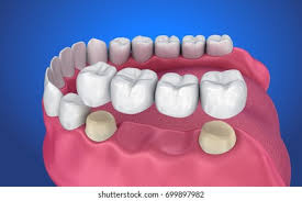 dental veneers in pragathi nagar