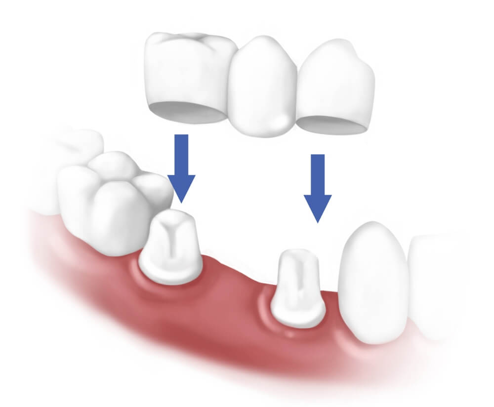 dental veneers in pragathi nagar