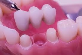 dental veneers in pragathi nagar