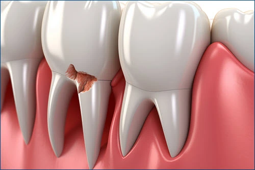 dental veneers in pragathi nagar