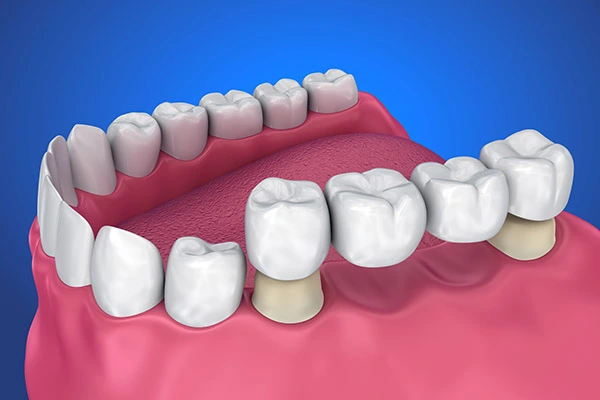 dental veneers in pragathi nagar