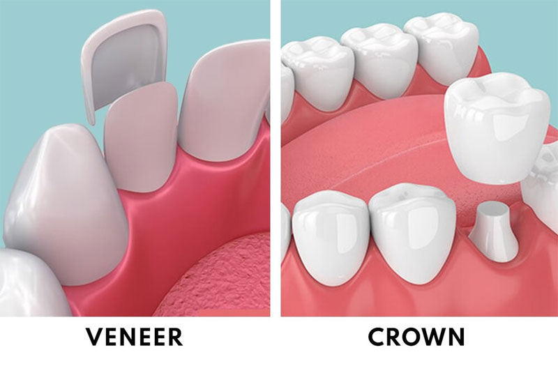 dental crowns & veneers in pragathi nagar