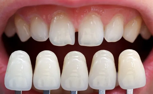 dental veneers in pragathi nagar
