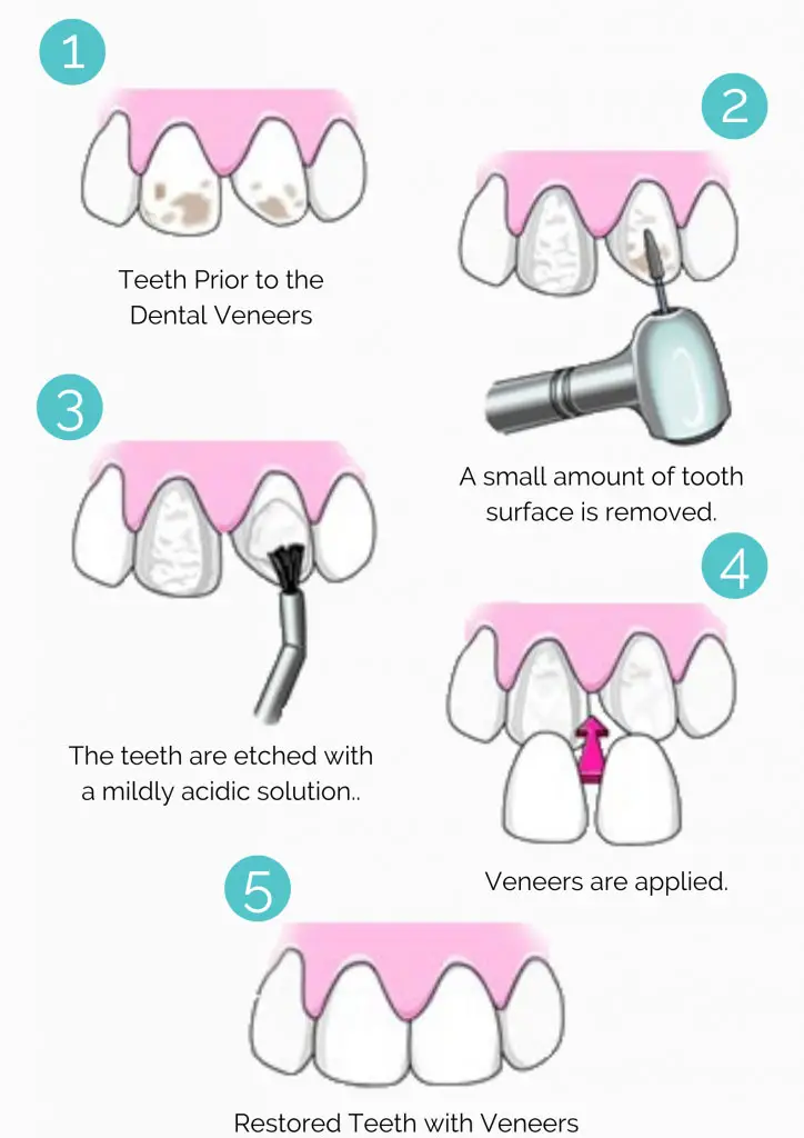 dental veneers in pragathi nagar