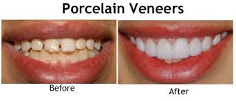 dental veneers in pragathi nagar