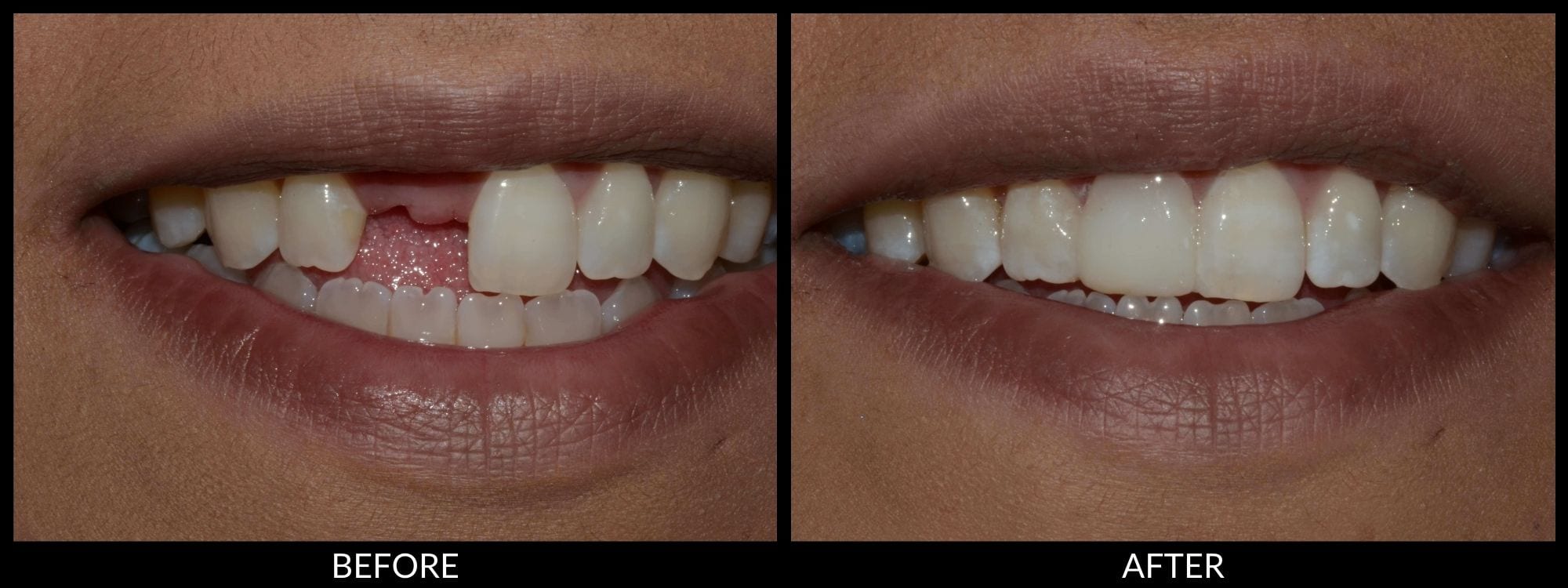 dental veneers in pragathi nagar