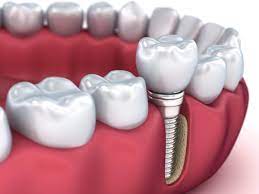 dental veneers in pragathi nagar