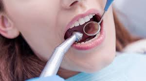 dental veneers in pragathi nagar