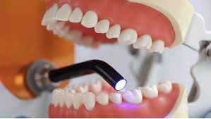 dental veneers in pragathi nagar