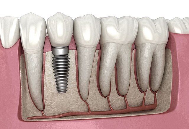dental veneers in pragathi nagar