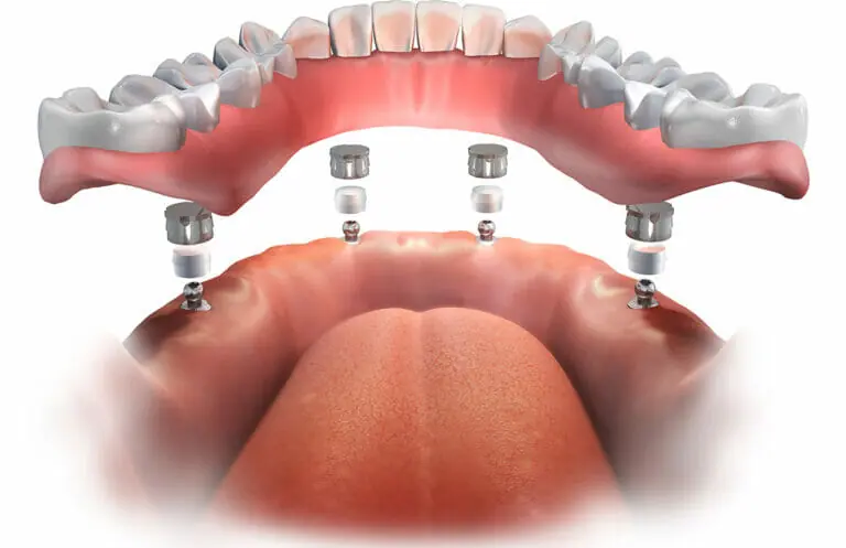 dental veneers in pragathi nagar