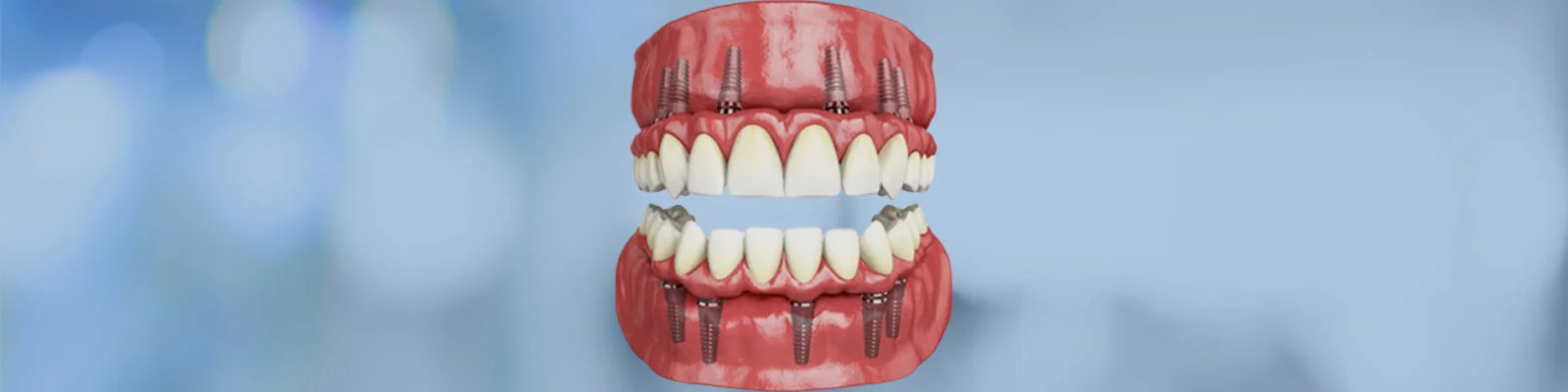 full mouth rehabilitaation