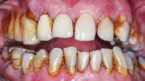 full mouth rehabilitation