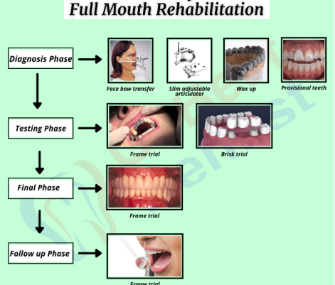dental crowns and bridges