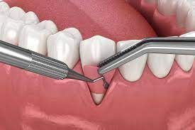 dental veneers in pragathi nagar