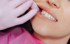 dental veneers in pragathi nagar