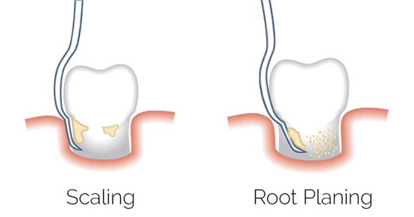 dental veneers in pragathi nagar