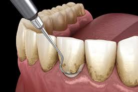 dental veneers in pragathi nagar