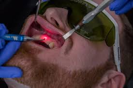 dental veneers in pragathi nagar