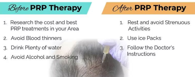 PRP Therapy