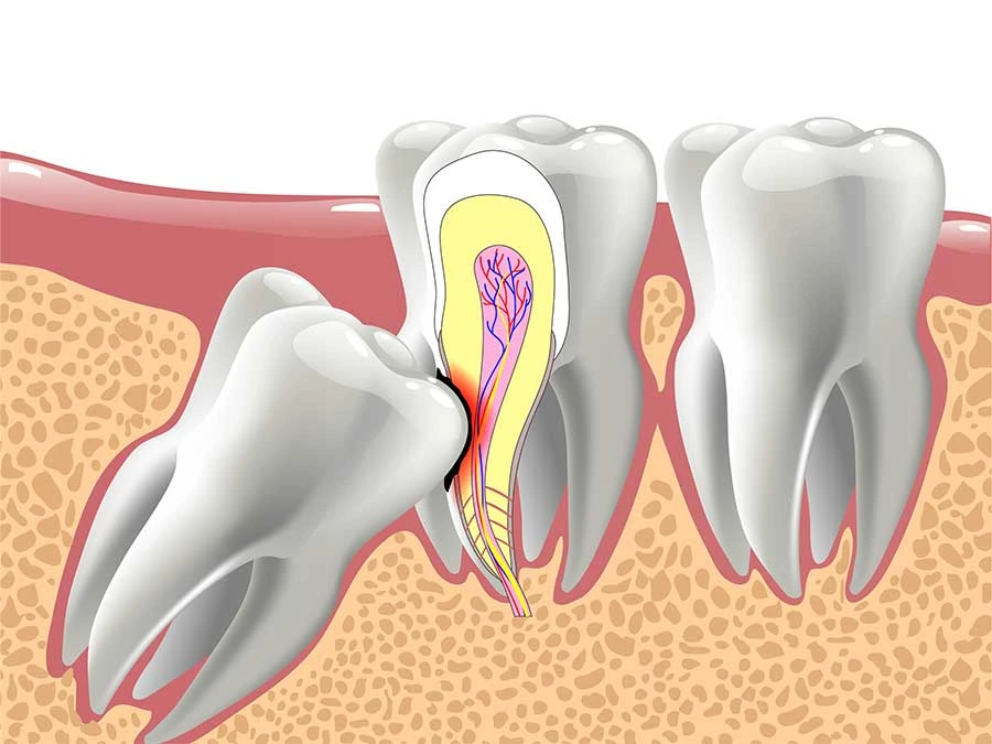 Impacted Wisdom Teeth