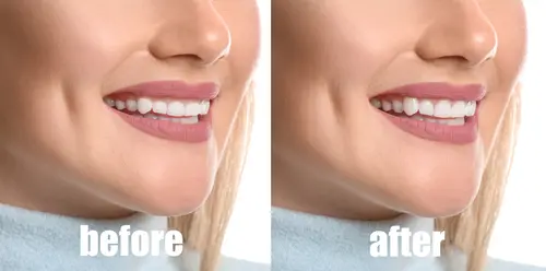 laser gum