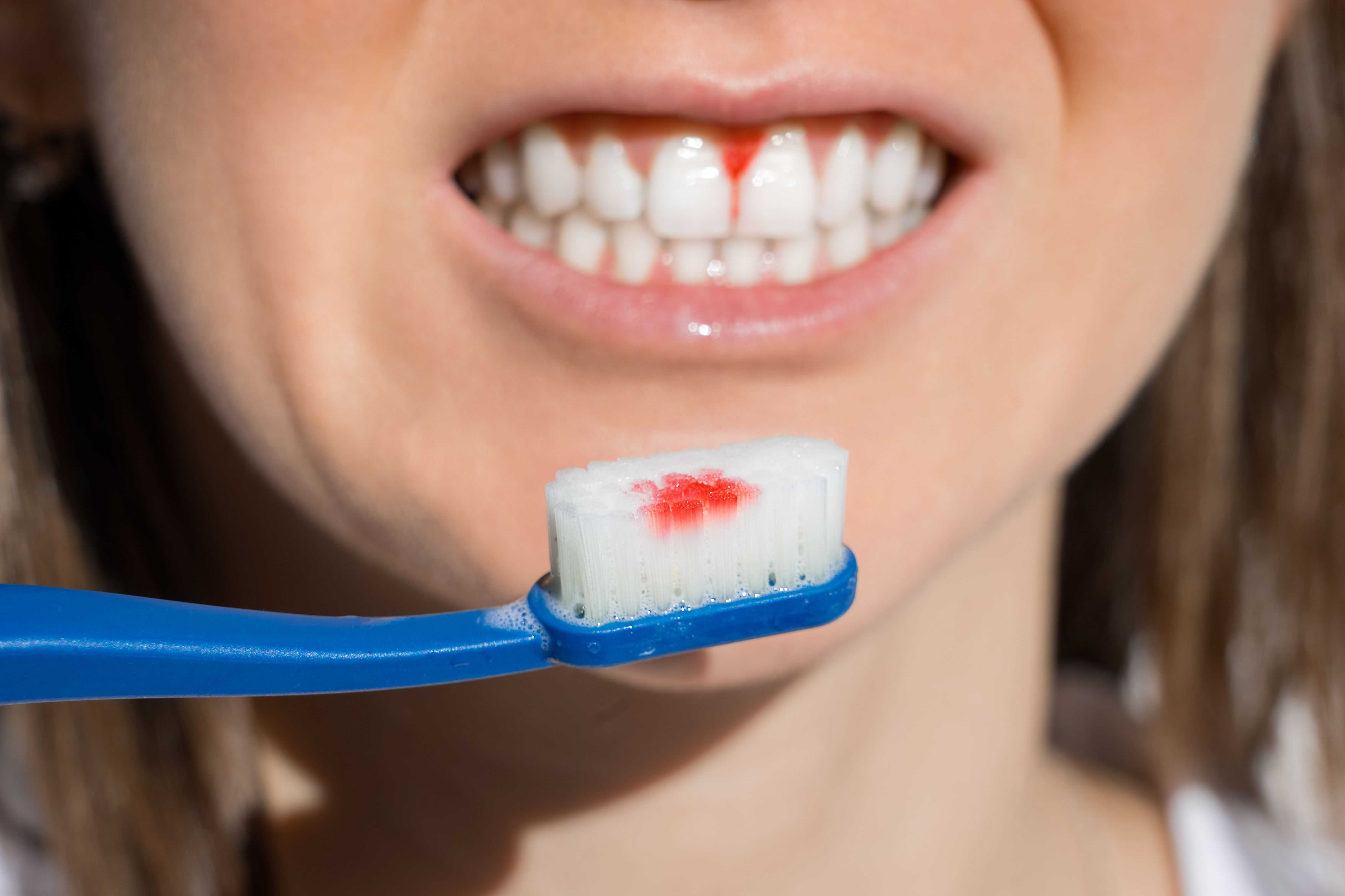 dental veneers in pragathi nagar